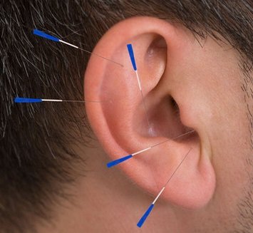 L’art de soigner par l’acupuncture de l’oreille — illustration 1