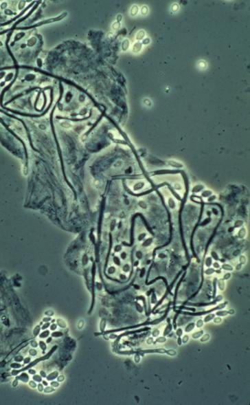 Dépression mentale et candida albicans en médecine chinoise